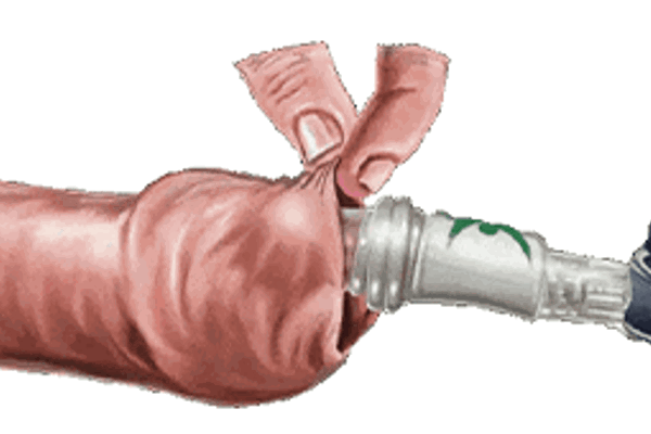 NOVOGLAN® Phimosis Treatment